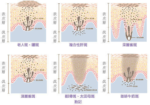 慈溪激光治疗老年斑前后需要注意哪些事项